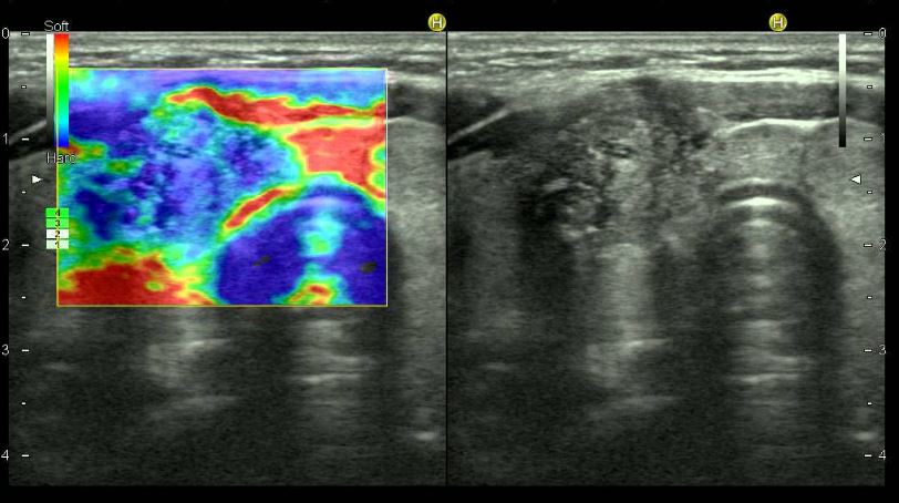 Elastografía completa