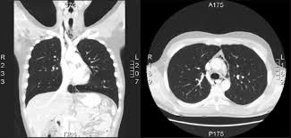 Radiología de Tórax con Tomografía